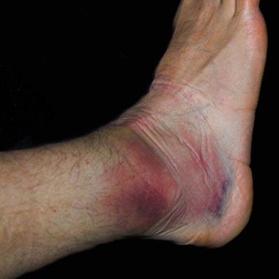 Ankle Sprain