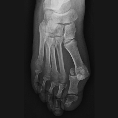 Foot Fracture