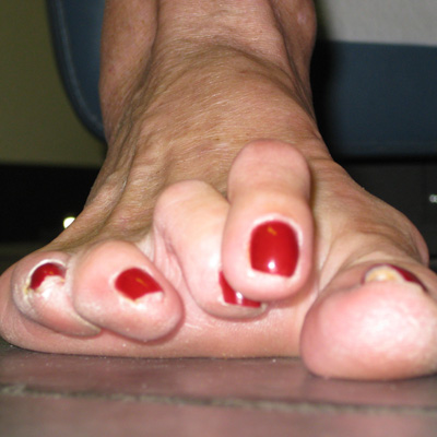 hammertoes