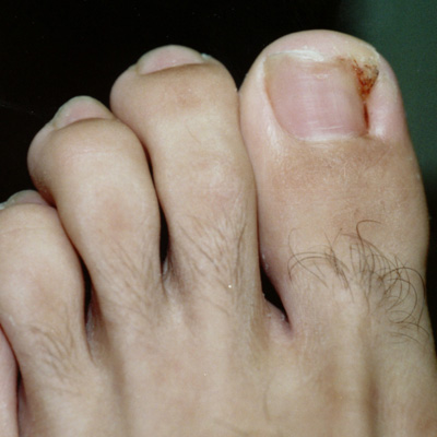 ingrown toenail