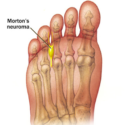 mortons neuroma