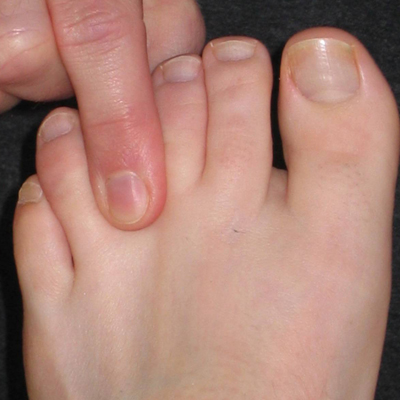 neuroma