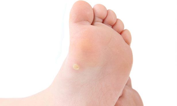 pediatric warts